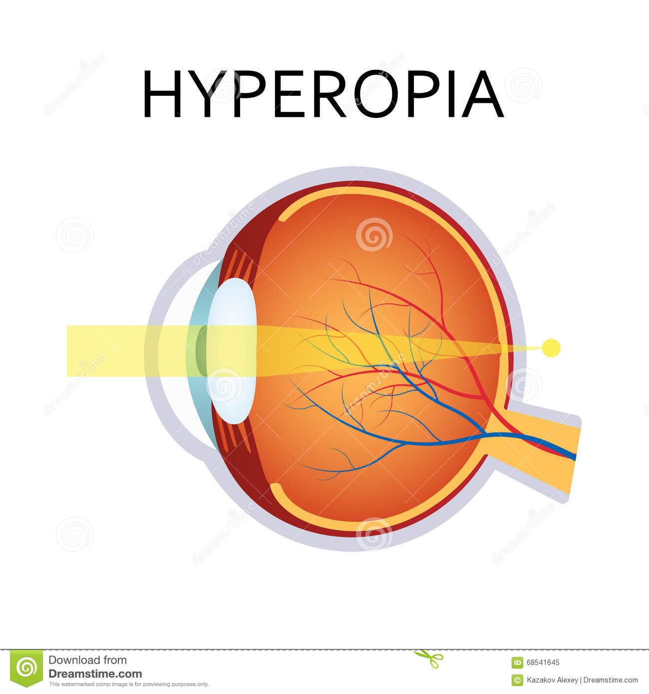 Farsightedness (hyperopia)
